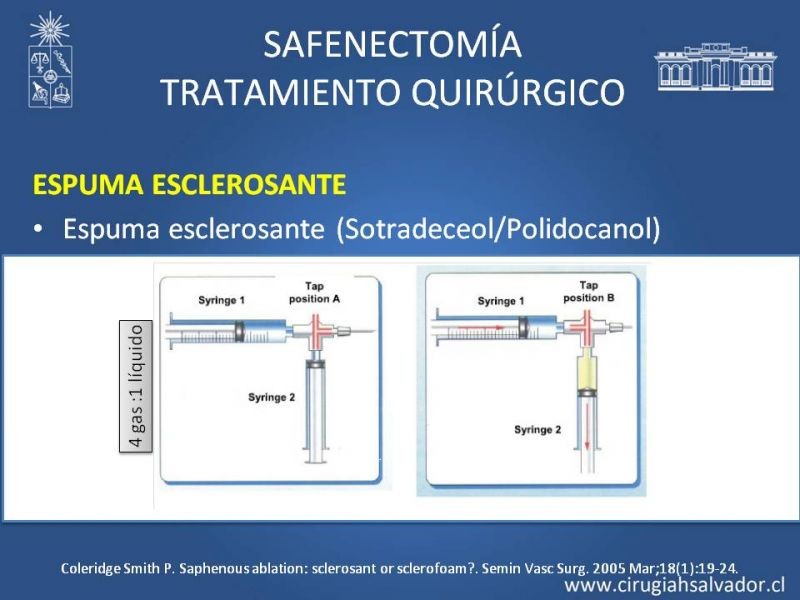 Diapositiva 33 de Safenectomía: técnica y resultados a largo plazo