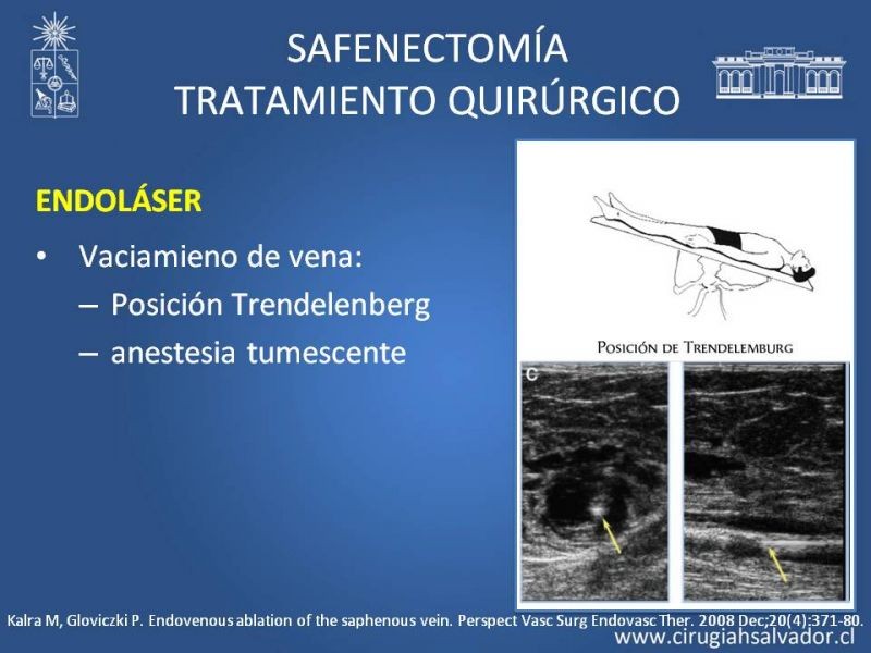 Diapositiva 24 de Safenectomía: técnica y resultados a largo plazo