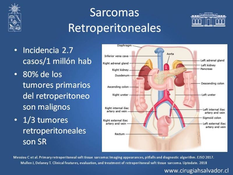 Diapositiva 3 de Sarcomas Retroperitoneales