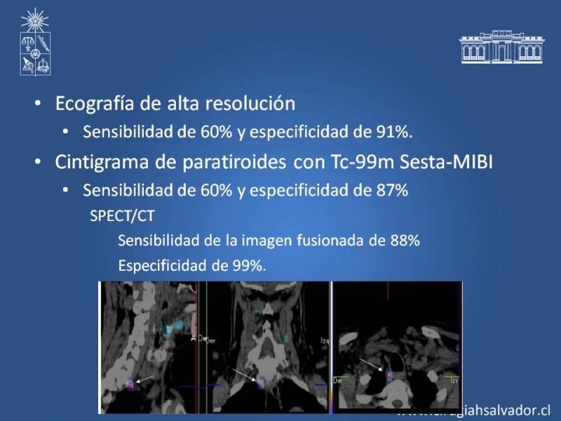 Diapositiva 14 de Hiperparatiroidismo 2°: Estudio, manejo e indic. Qx