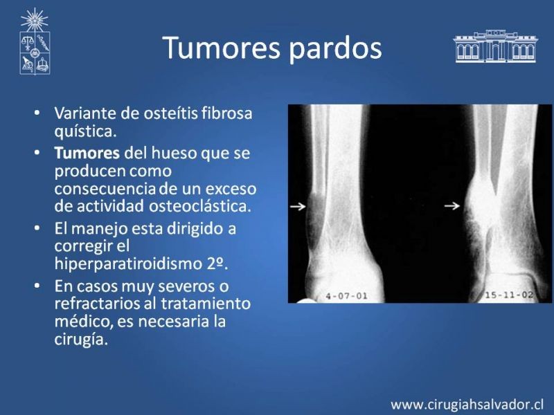 Diapositiva 10 de Hiperparatiroidismo 2°: Estudio, manejo e indic. Qx