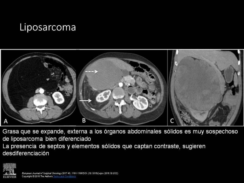 Diapositiva 9 de Sarcomas Retroperitoneales
