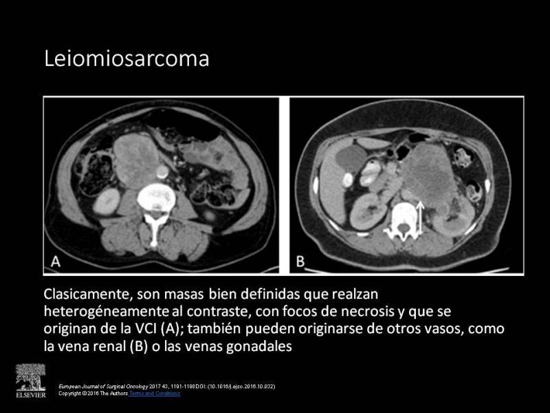 Diapositiva 11 de Sarcomas Retroperitoneales