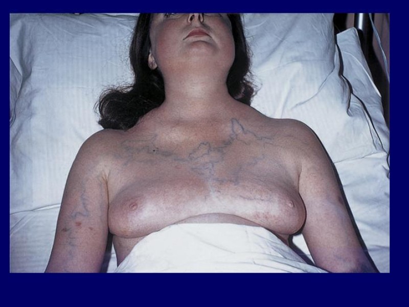 Diapositiva 7 de Síndrome Vena Cava Superior
