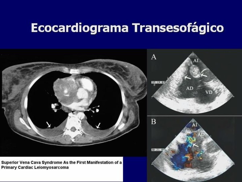 Diapositiva 15 de Síndrome Vena Cava Superior