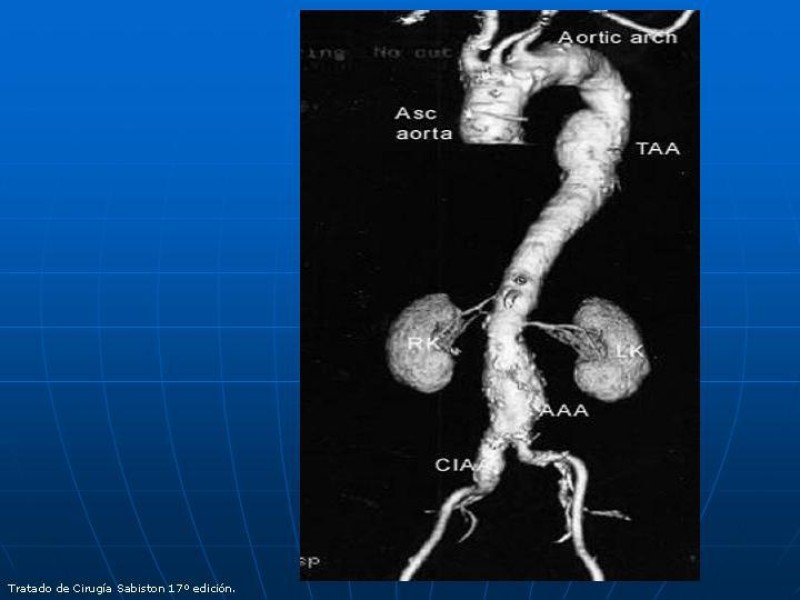 Diapositiva 29 de Aneurisma aórtico toracoabdominal (AATA)