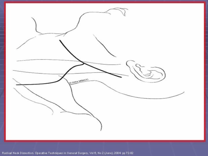 Diapositiva 3 de Disección Cervical Pt. 2