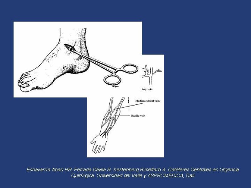Diapositiva 24 de Accesos venosos centrales
