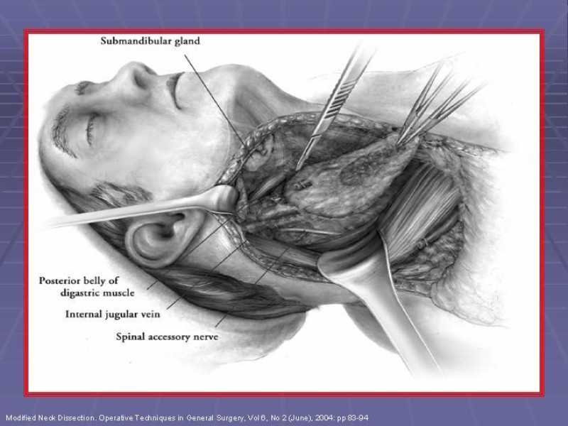 Diapositiva 42 de Disección Cervical Pt. 2
