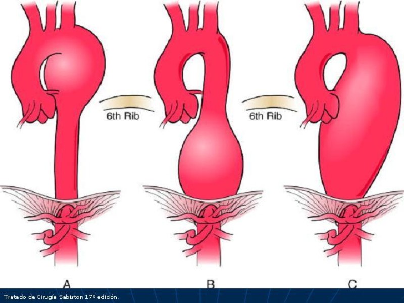 Diapositiva 7 de Aneurisma aórtico toracoabdominal (AATA)