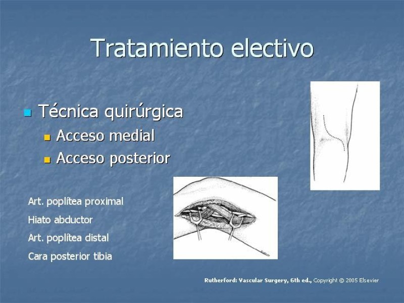 Diapositiva 14 de Aneurisma arterial poplíteo