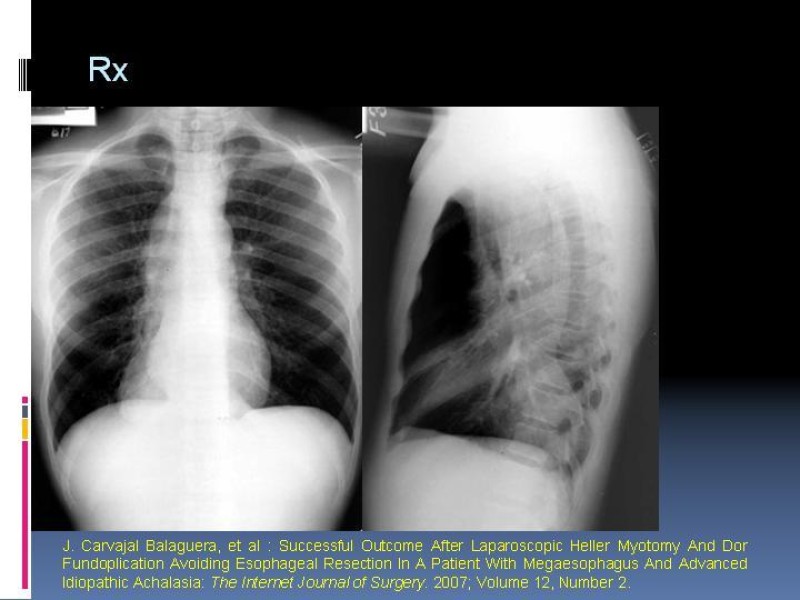 Diapositiva 4 de Acalasia