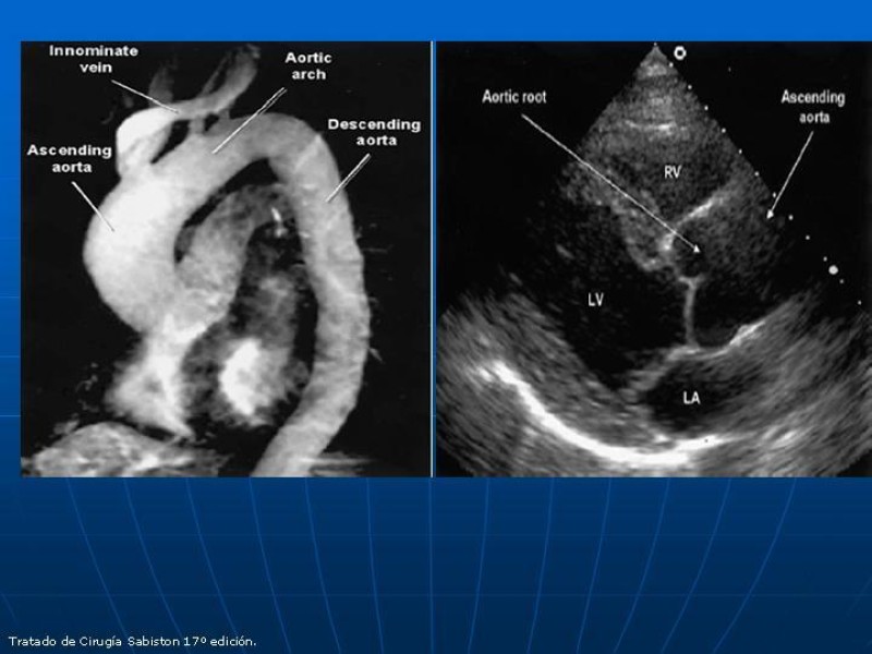 Diapositiva 25 de Aneurisma aórtico toracoabdominal (AATA)