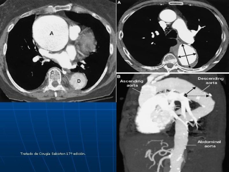 Diapositiva 24 de Aneurisma aórtico toracoabdominal (AATA)