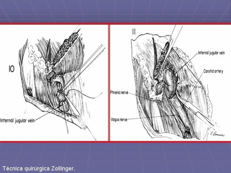 Diapositiva 24 de Disección Cervical Pt. 2