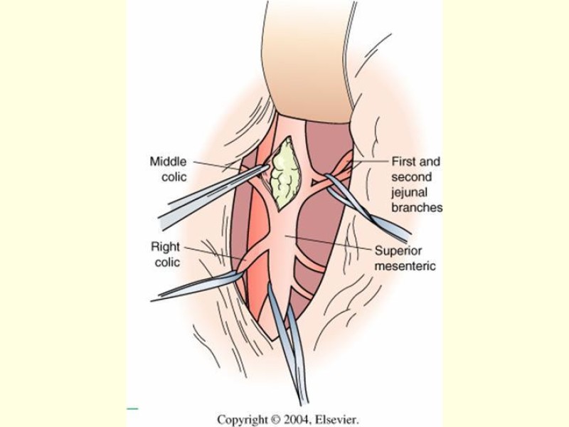 Diapositiva 20 de Isquemia Mesentérica Aguda