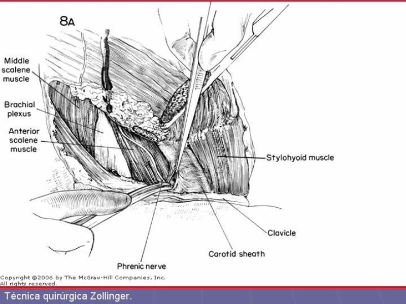 Diapositiva 21 de Disección Cervical Pt. 2