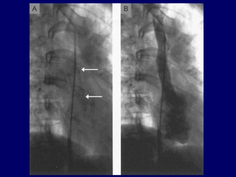 Diapositiva 25 de Síndrome Vena Cava Superior