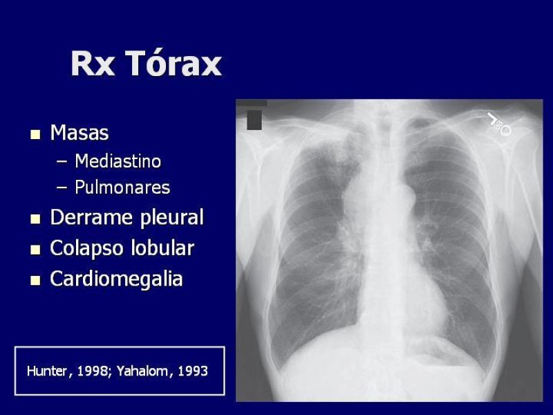 Diapositiva 10 de Síndrome Vena Cava Superior