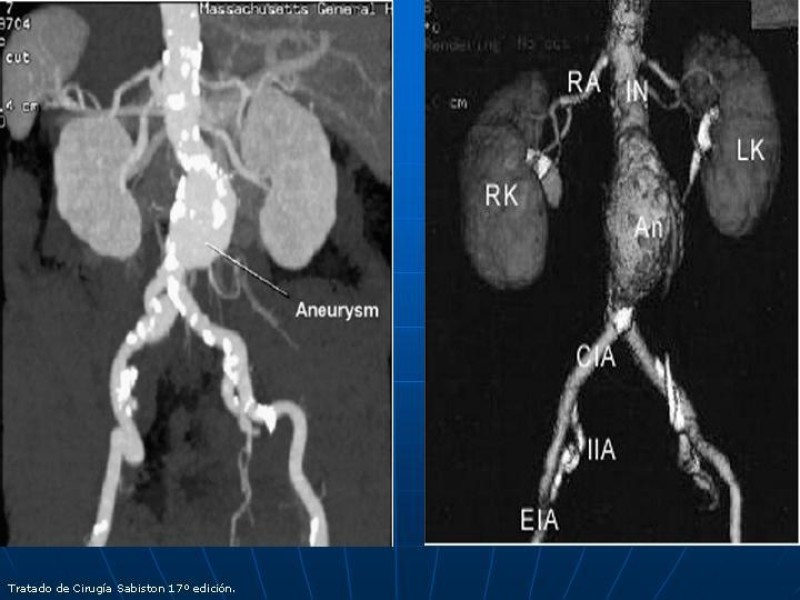 Diapositiva 26 de Aneurisma aórtico toracoabdominal (AATA)