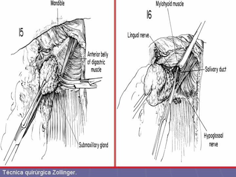 Diapositiva 33 de Disección Cervical Pt. 2