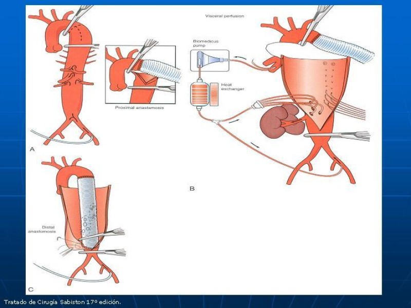 Diapositiva 55 de Aneurisma aórtico toracoabdominal (AATA)