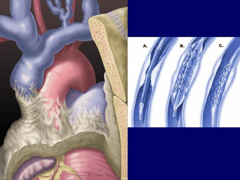 Diapositiva 23 de Síndrome Vena Cava Superior