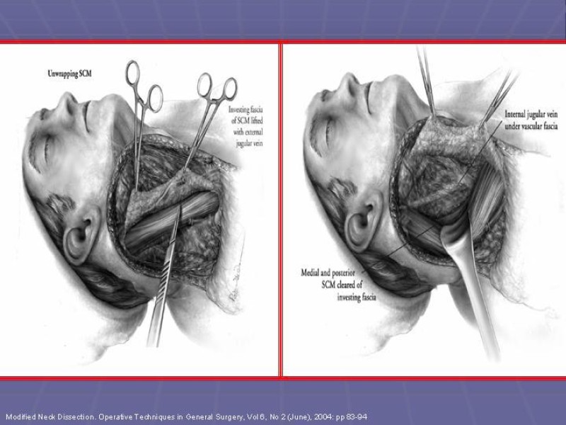 Diapositiva 40 de Disección Cervical Pt. 2