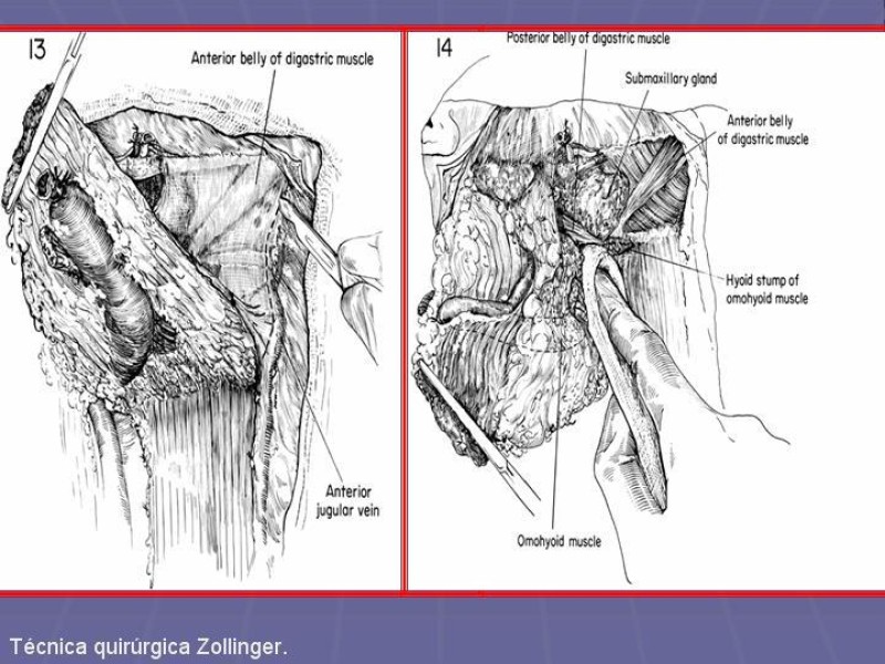 Diapositiva 32 de Disección Cervical Pt. 2