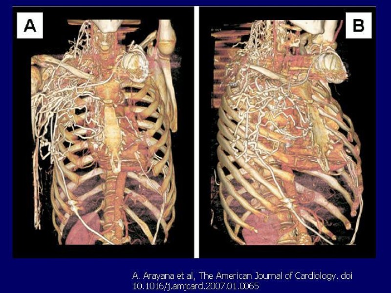 Diapositiva 13 de Síndrome Vena Cava Superior