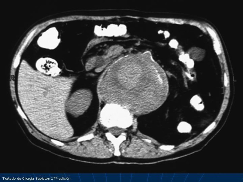 Diapositiva 18 de Aneurisma aórtico toracoabdominal (AATA)