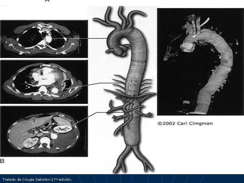 Diapositiva 57 de Aneurisma aórtico toracoabdominal (AATA)