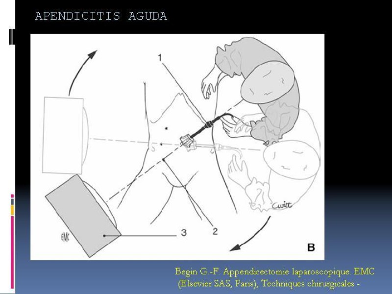 Diapositiva 30 de Apendicitis aguda