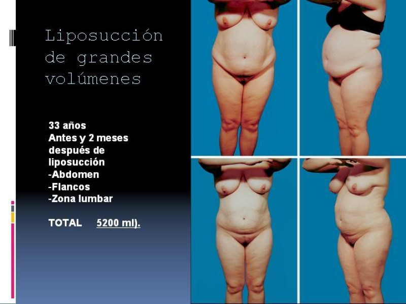 Diapositiva 17 de Liposucción