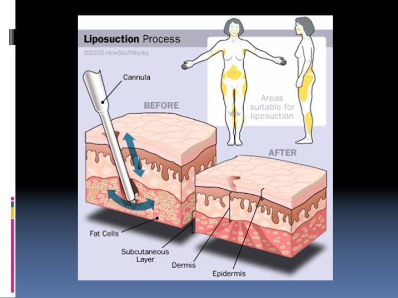 Diapositiva 2 de Liposucción