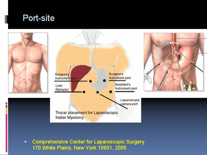 Diapositiva 14 de Acalasia