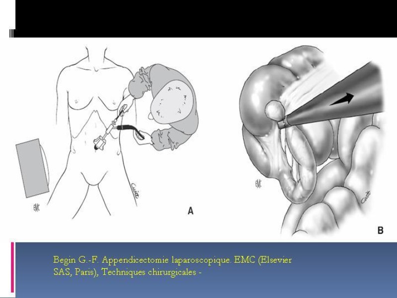 Diapositiva 36 de Apendicitis aguda