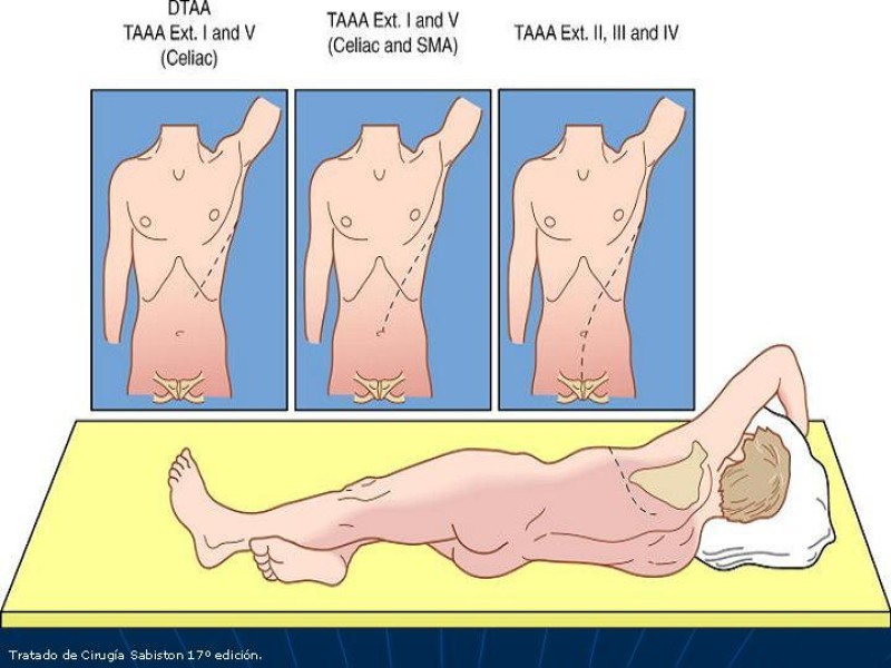 Diapositiva 53 de Aneurisma aórtico toracoabdominal (AATA)