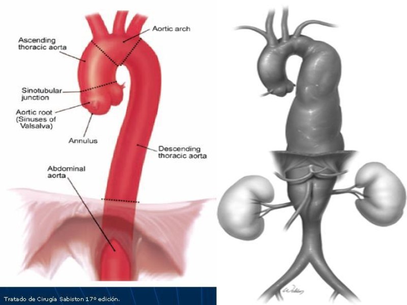 Diapositiva 5 de Aneurisma aórtico toracoabdominal (AATA)