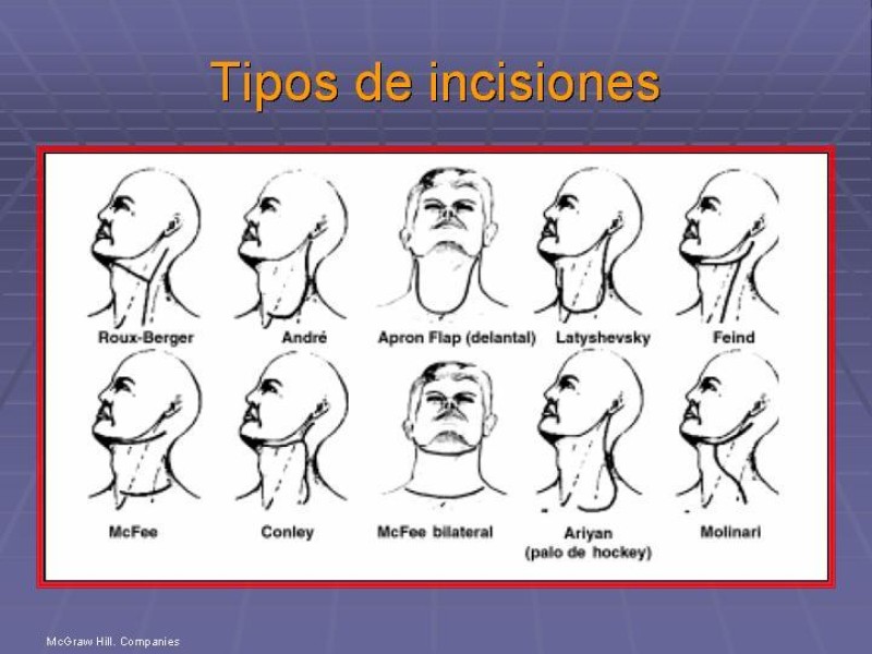 Diapositiva 43 de Disección Cervical Pt. 1