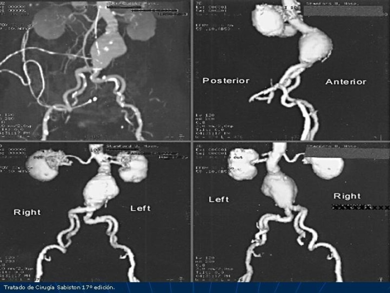 Diapositiva 27 de Aneurisma aórtico toracoabdominal (AATA)