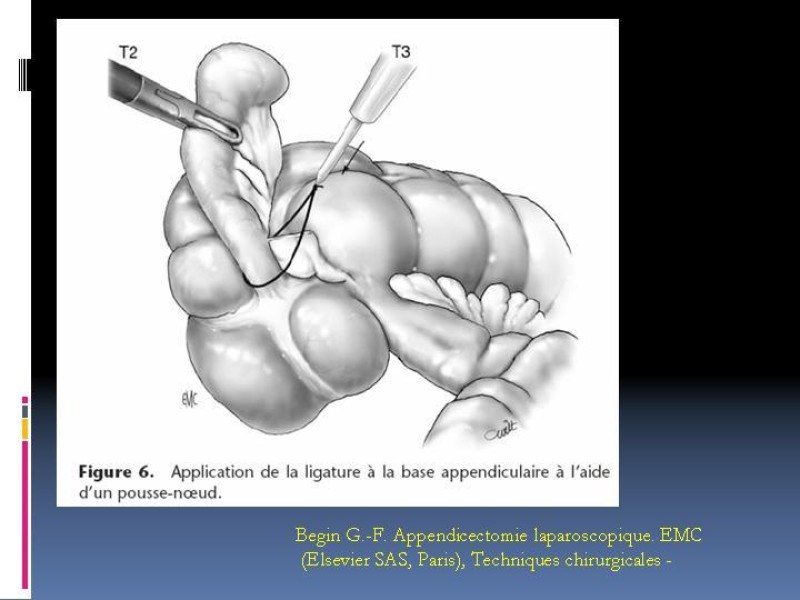 Diapositiva 33 de Apendicitis aguda
