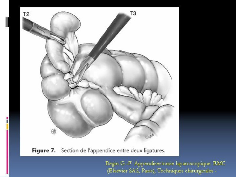 Diapositiva 34 de Apendicitis aguda