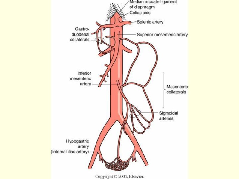 Diapositiva 3 de Isquemia Mesentérica Aguda