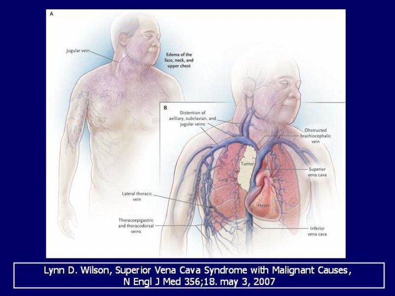 Diapositiva 6 de Síndrome Vena Cava Superior