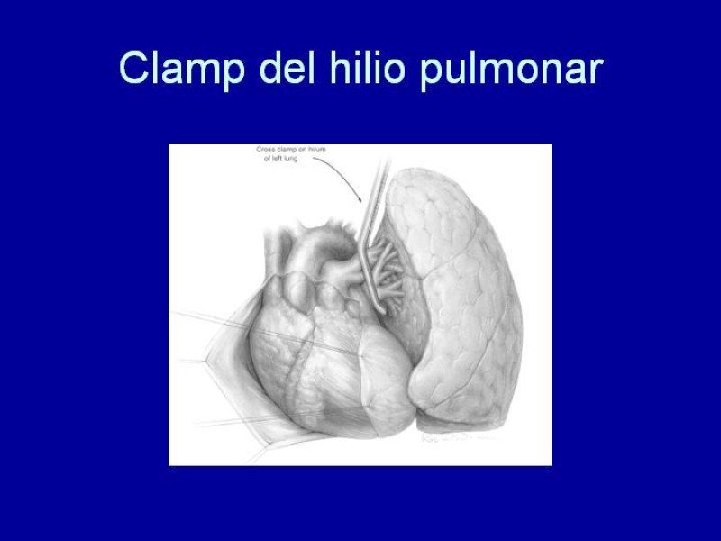 Diapositiva 15 de Toracotomía de Reanimación
