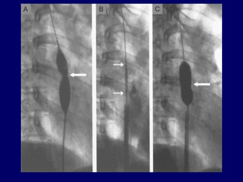 Diapositiva 24 de Síndrome Vena Cava Superior