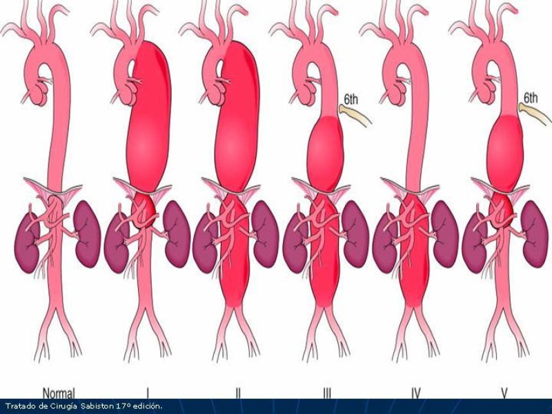Diapositiva 9 de Aneurisma aórtico toracoabdominal (AATA)