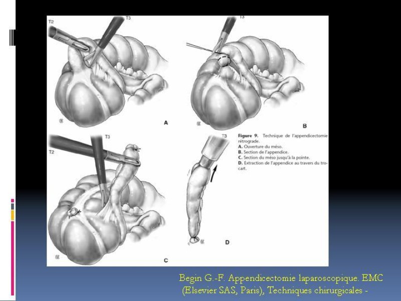 Diapositiva 35 de Apendicitis aguda