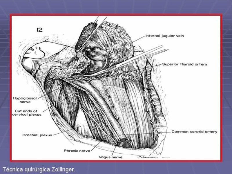 Diapositiva 26 de Disección Cervical Pt. 2